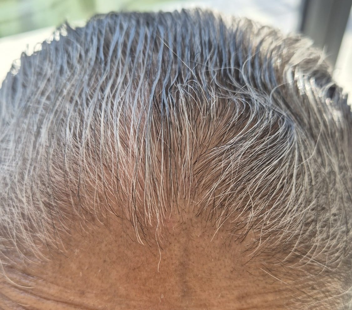 After Hair & Scalp Problems