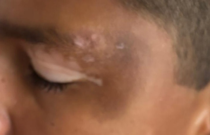 After Vitiligo