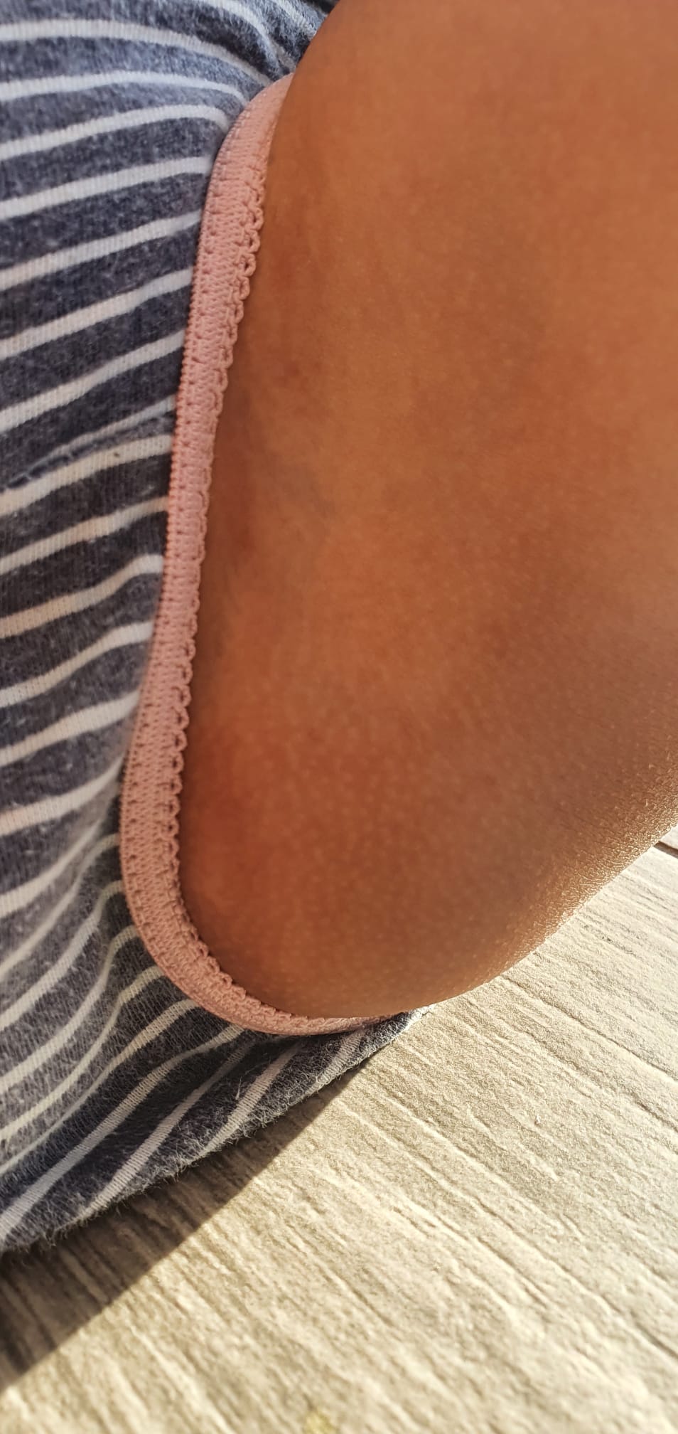 After Vitiligo