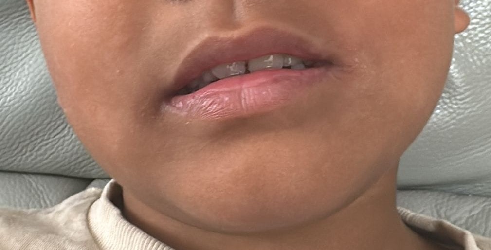 After Vitiligo