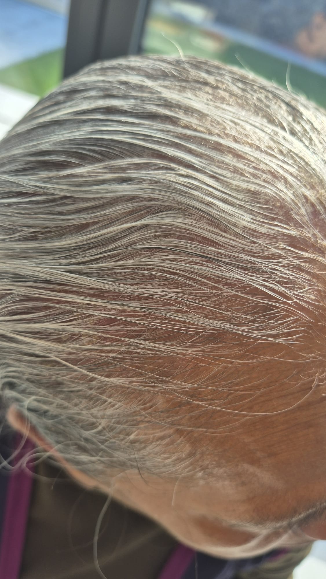 After Hair & Scalp Problems
