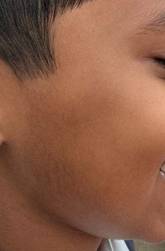 After Pityriasis Alba