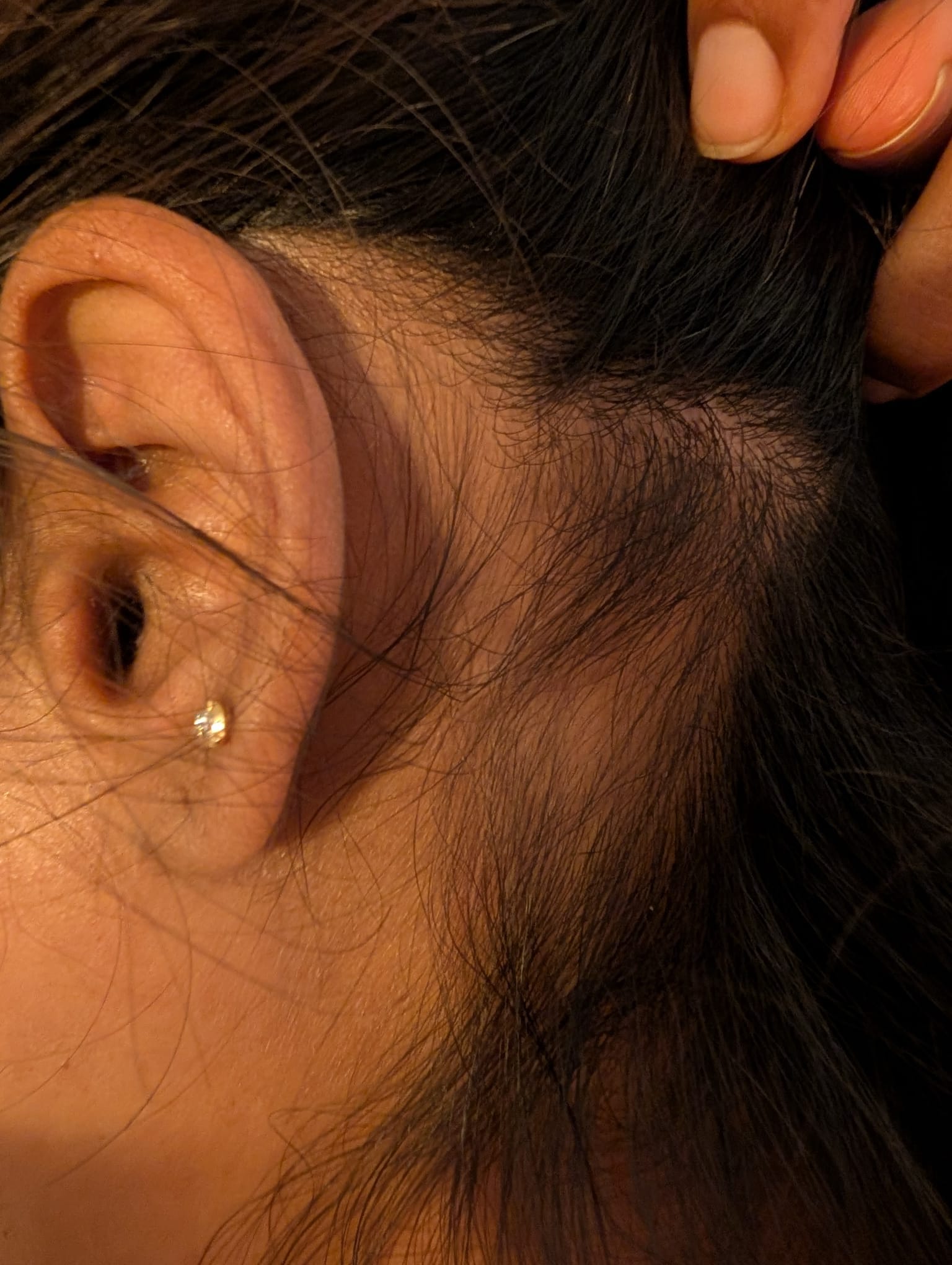 After Alopecia 