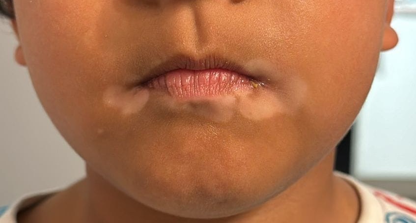 Before Vitiligo