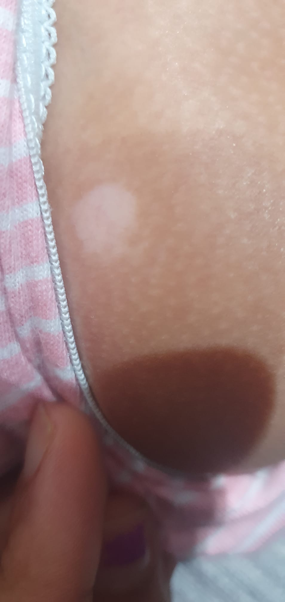 Before Vitiligo