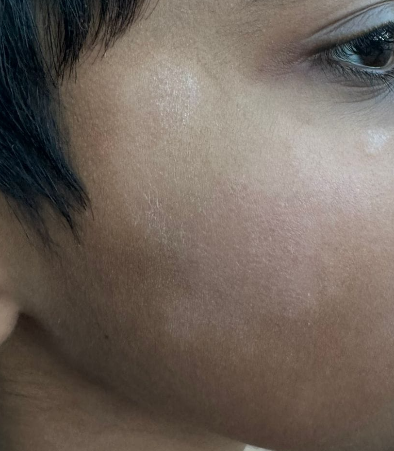 Before Pityriasis Alba