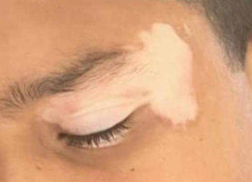 Before Vitiligo
