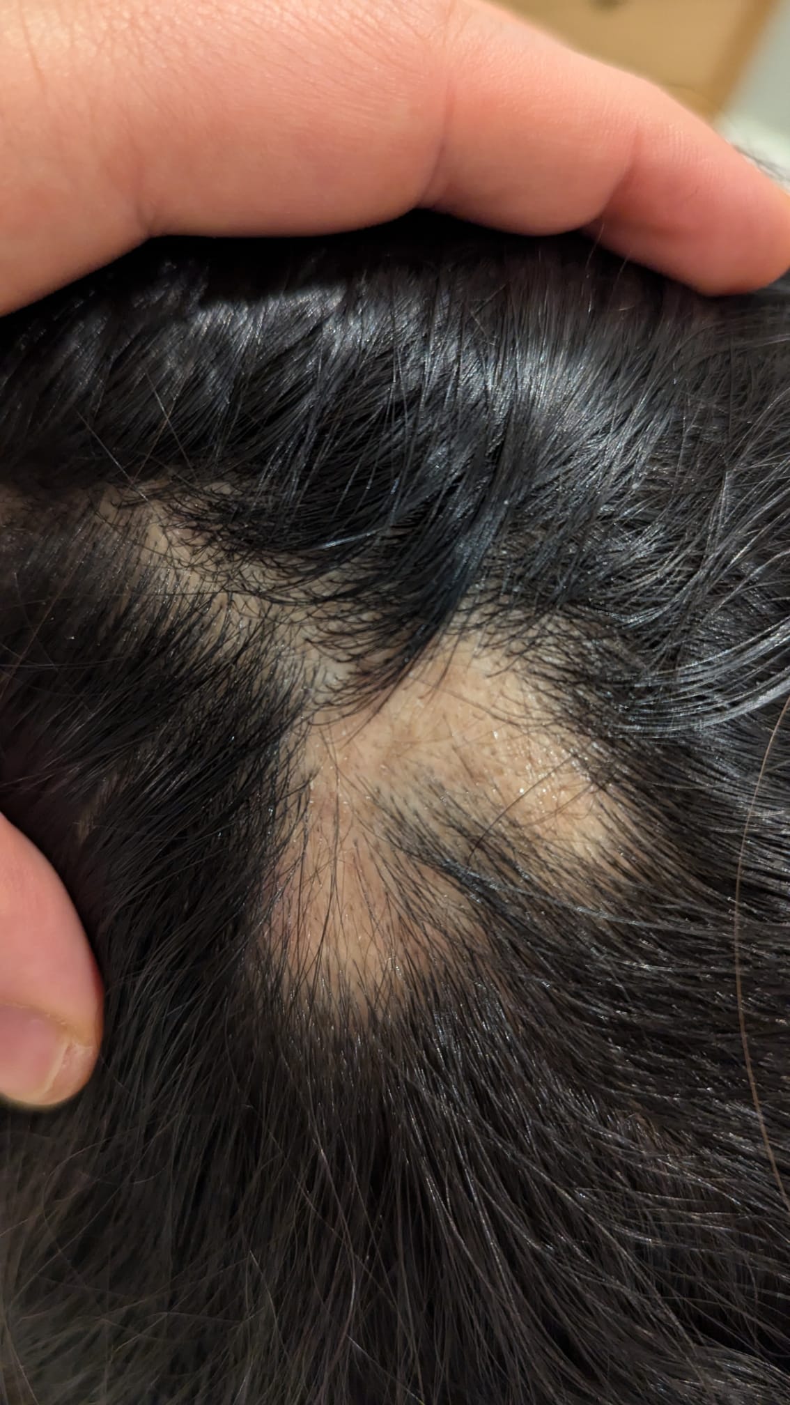 Before Alopecia 