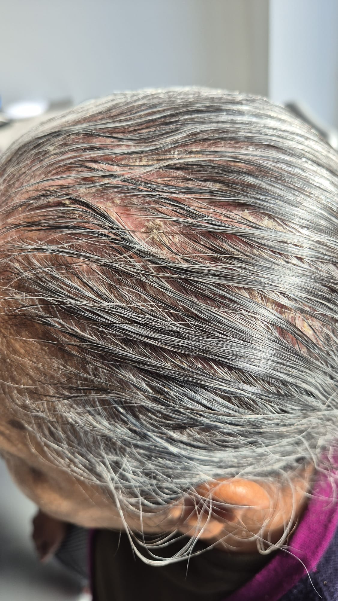 Before Hair & Scalp Problems